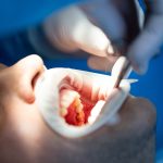 جراحی دندان و انواع آن
