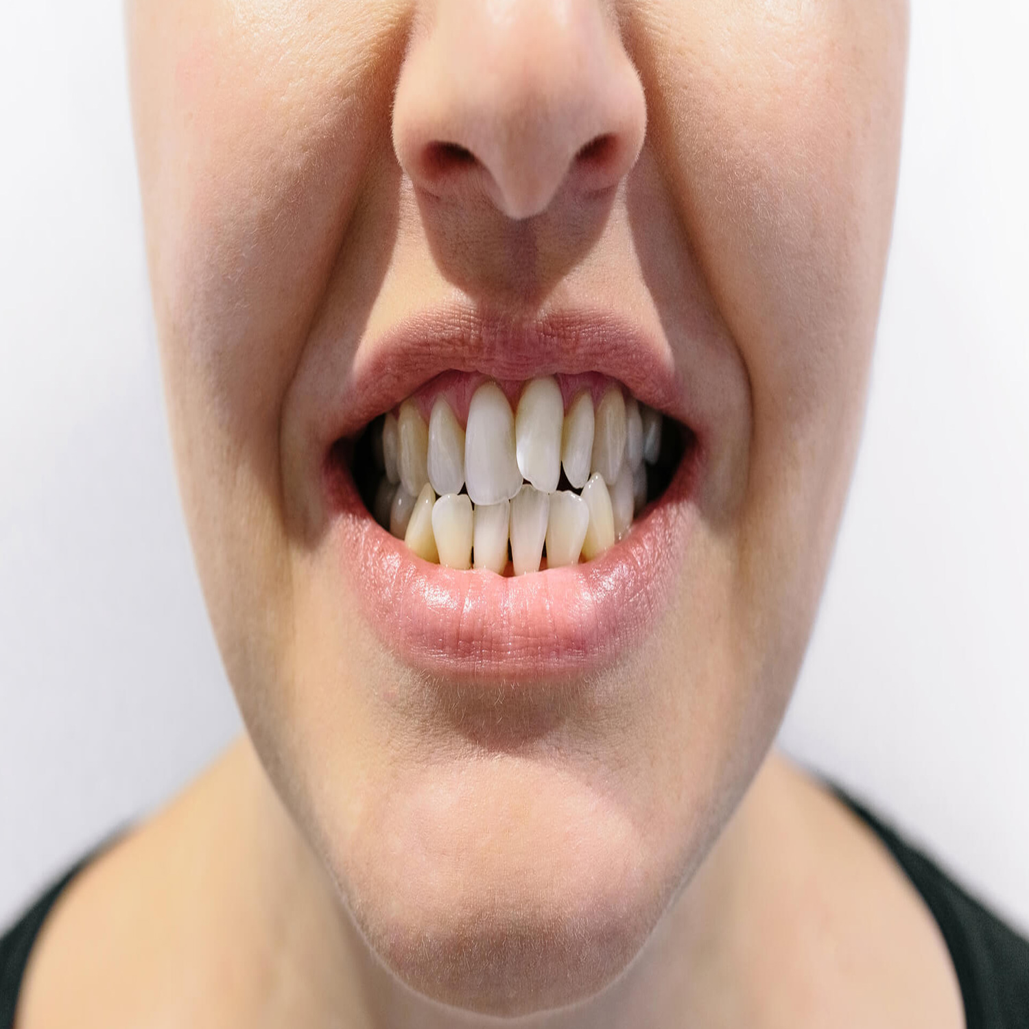 نامنظمی دندان و رشد کج دندان‌ها