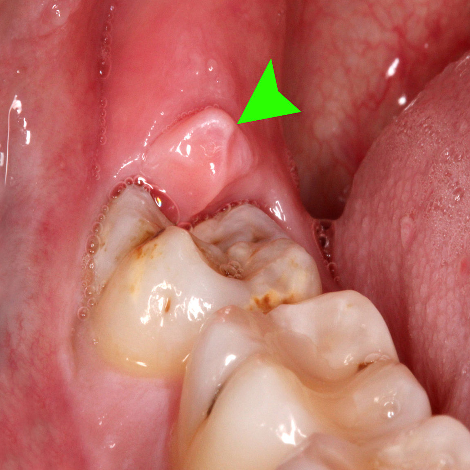 آبسه دندان عفونتی است که در اثر تجمع باکتری‌ها ایجاد می‌شود.