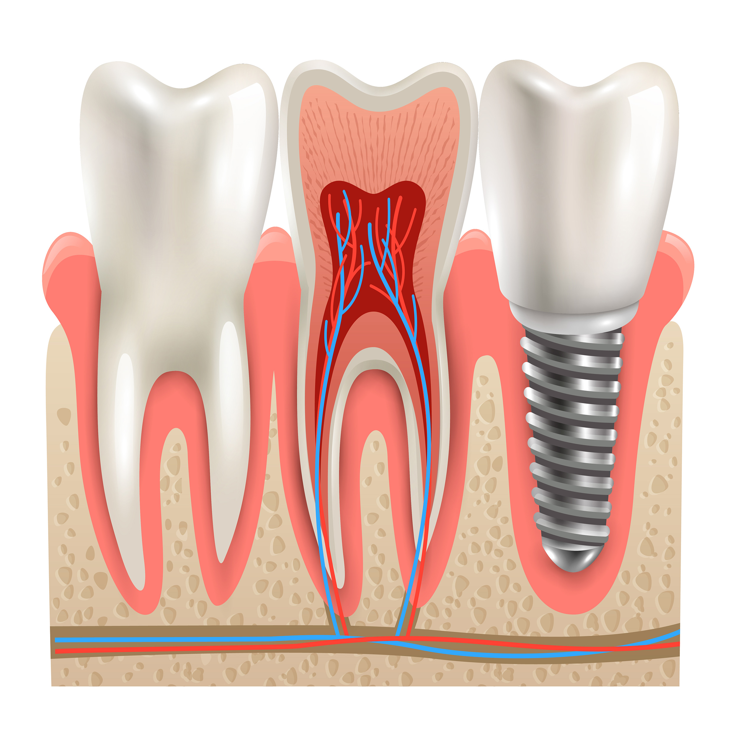 مهم‌ترین مزیت پیوند استخوان فک، بالا بردن احتمال موفقیت ایمپلنت دندان و کاشت دندان است.