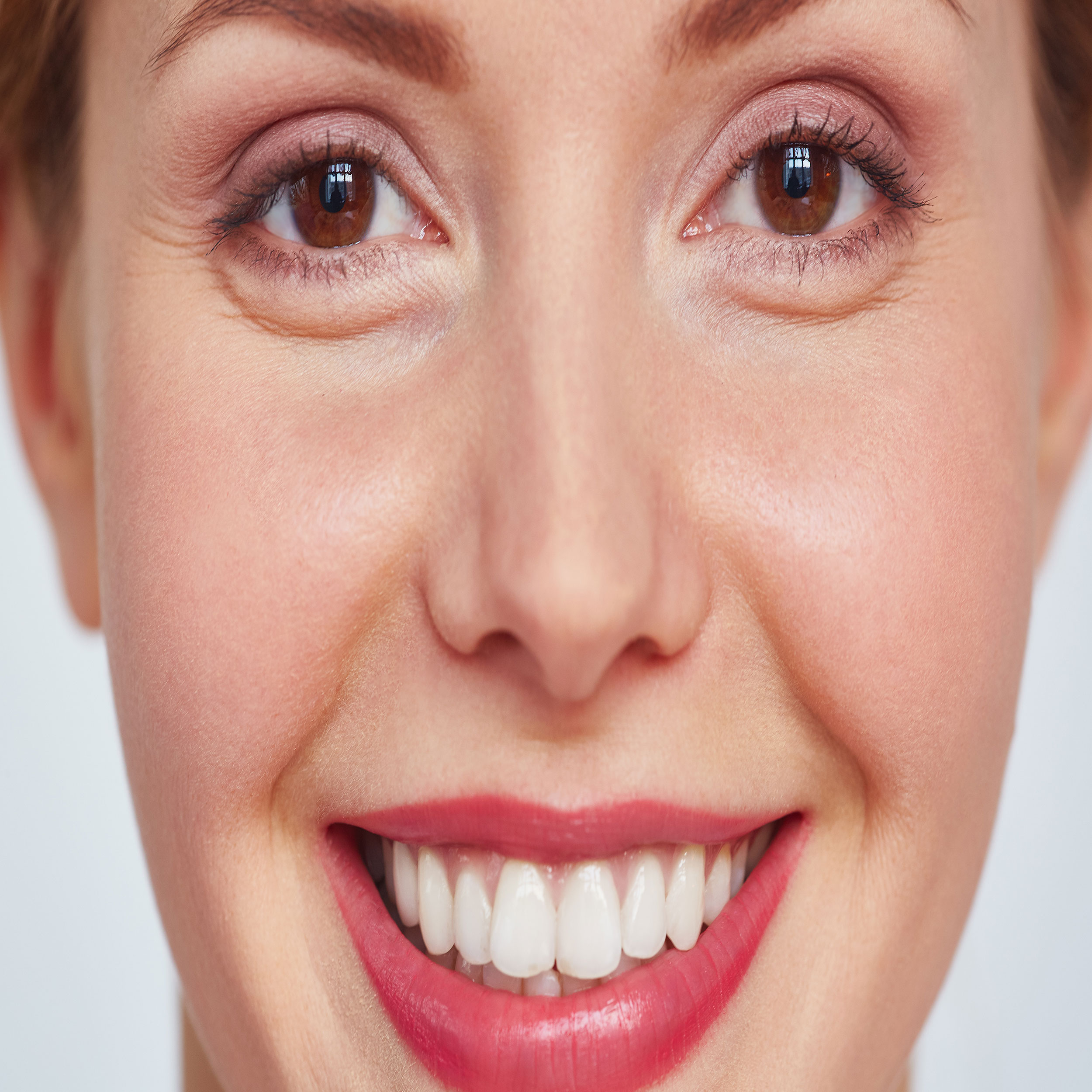 کامپوزیت ونیر برای اصلاح طرح لبخند و عیوب جزیی دندان است.
