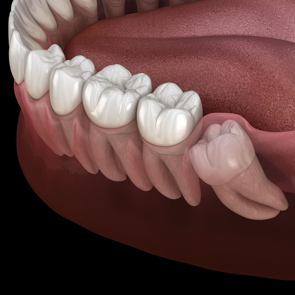 اگر فضای کافی برای درآمدن دندان عقل در انتهای فک وجود نداشته باشد، این دندان کج می‌شود.